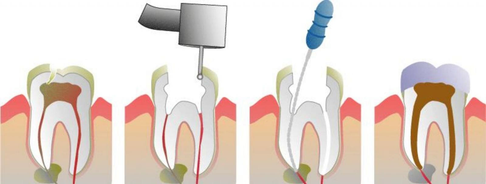 Root Canal Treatment